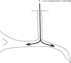 Рис. 10. Доступ в желчные протоки через наружный желчный свищ, сформированный на Т-образном дренаже